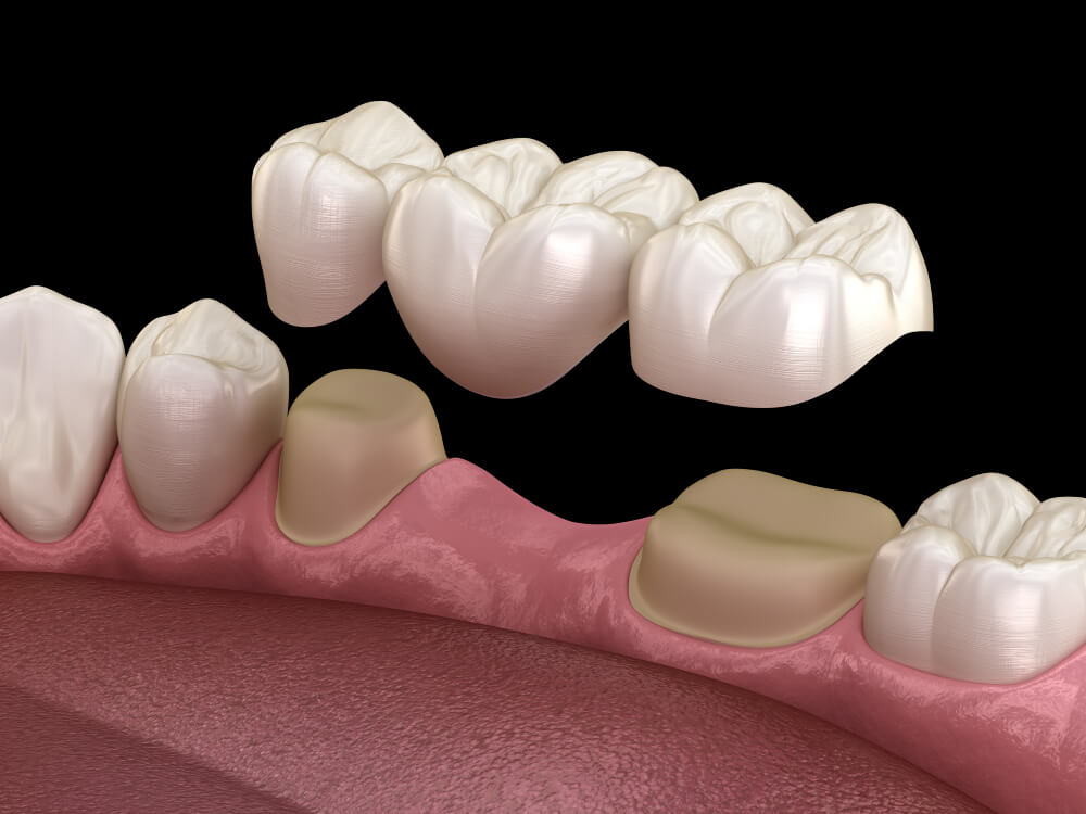 Tallado-puente-dental